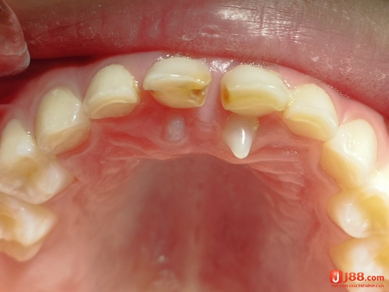 Mơ thấy mọc nhiều răng cùng lúc tượng trưng cho sự sung túc và tài lộc đang đến