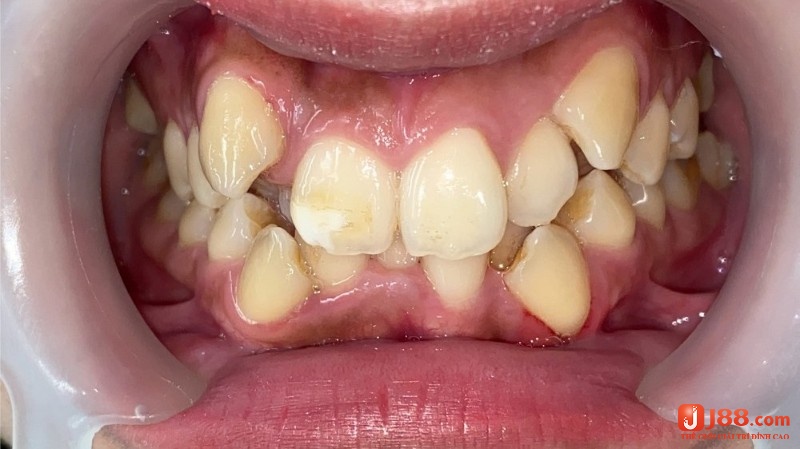 Mơ thấy răng mọc lệch là điềm bạn đang đối diện với những khó khăn trong việc hòa nhập