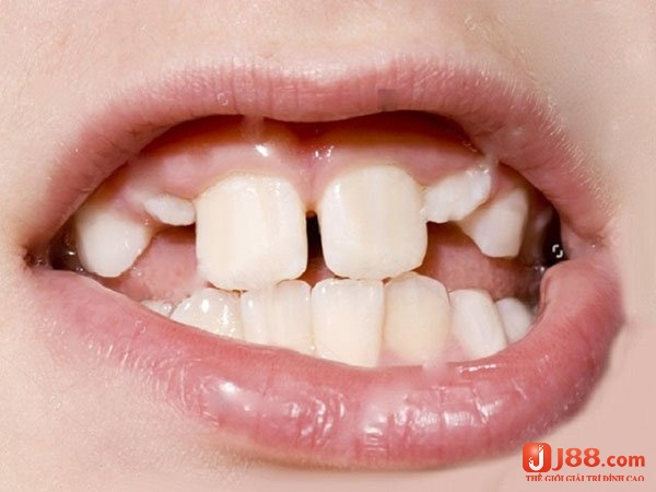Mơ thấy mọc răng cửa cho thấy sự khởi đầu của một mối quan hệ