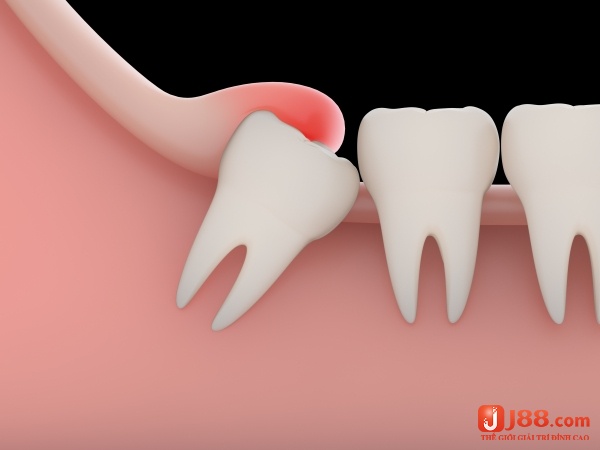 Mơ thấy mọc răng bị đau thể hiện sự lo lắng hoặc khó chịu với một vấn đề